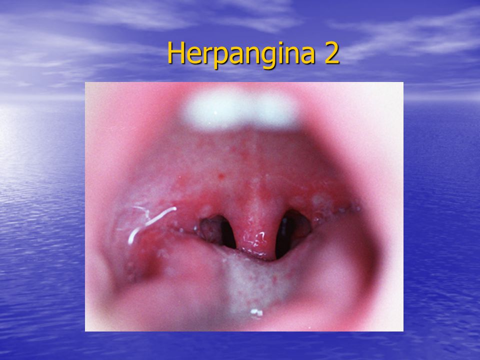 Herpangina 2