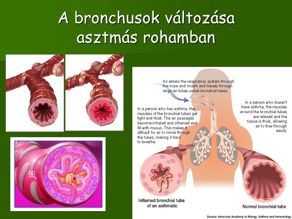 A bronchusok változása asztmás rohamban
