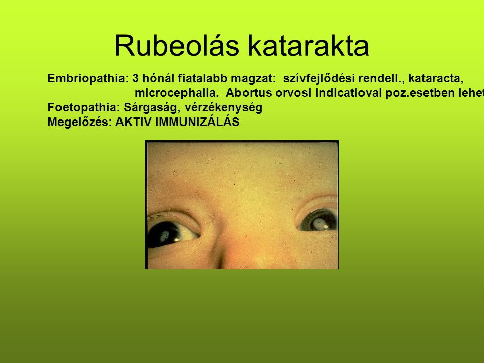 Rubeolás katarakta Embriopathia: 3 hónál fiatalabb magzat: szívfejlődési rendell., kataracta,