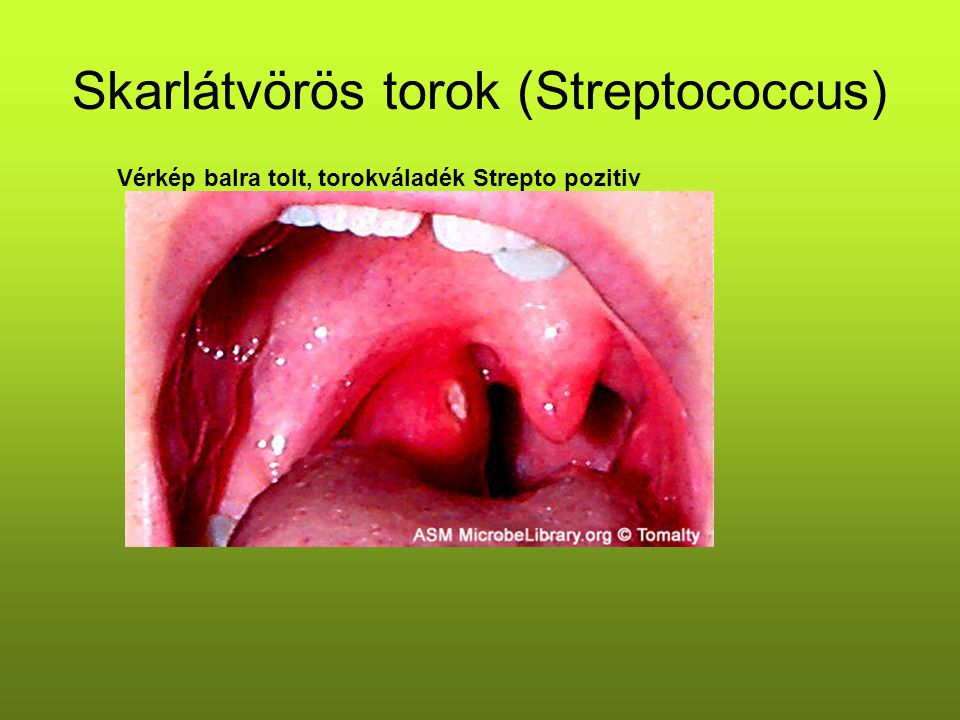 Skarlátvörös torok (Streptococcus)
