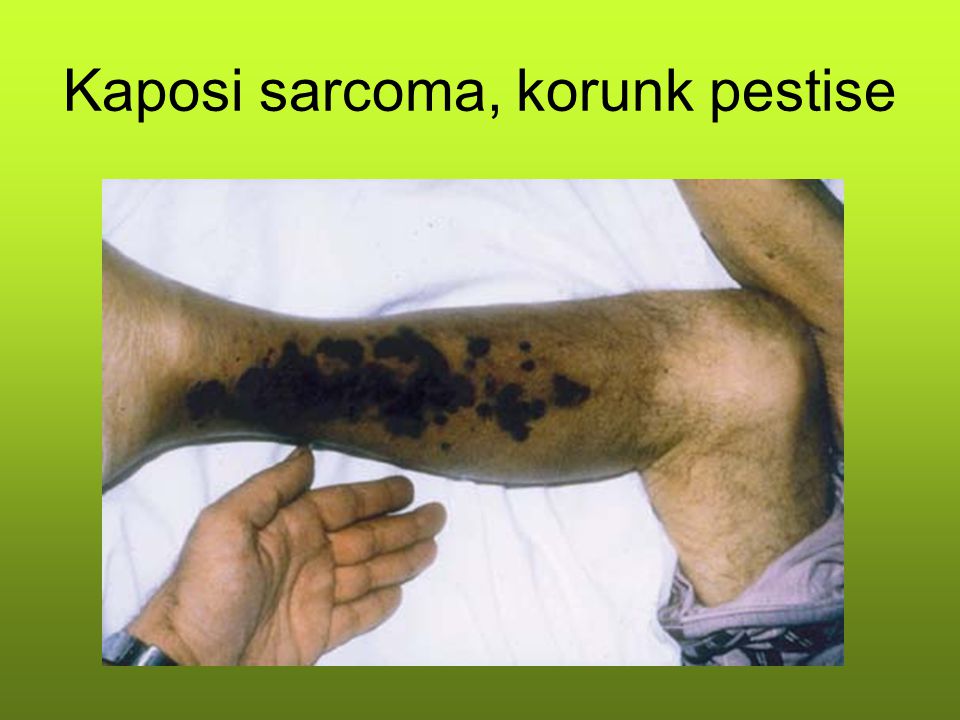 Kaposi sarcoma, korunk pestise