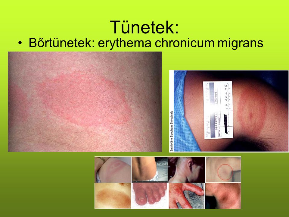 Tünetek: Bőrtünetek: erythema chronicum migrans