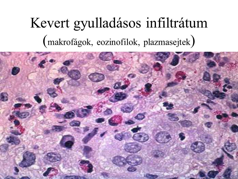 Kevert gyulladásos infiltrátum (makrofágok, eozinofilok, plazmasejtek)
