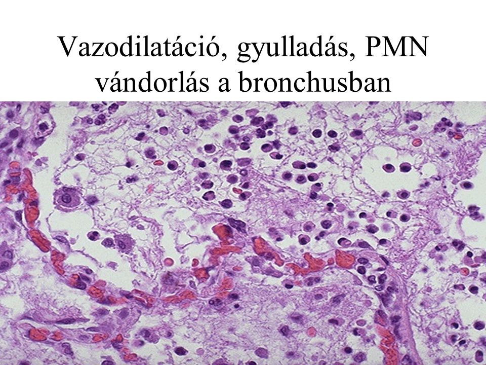 Vazodilatáció, gyulladás, PMN vándorlás a bronchusban