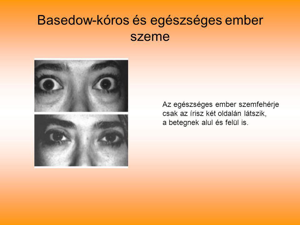 Basedow-kóros és egészséges ember szeme