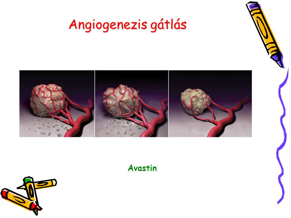 Angiogenezis gátlás Avastin