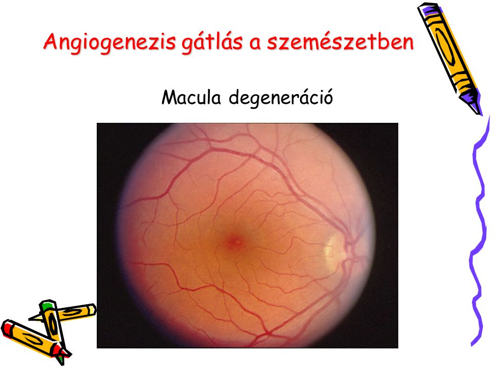Angiogenezis gátlás a szemészetben