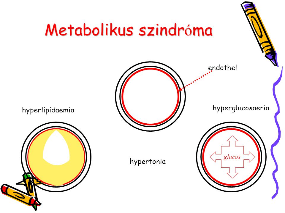 metabolikus szindróma hipertónia kezelése)
