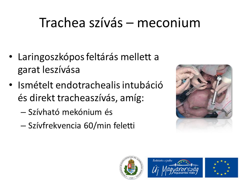 Trachea szívás – meconium