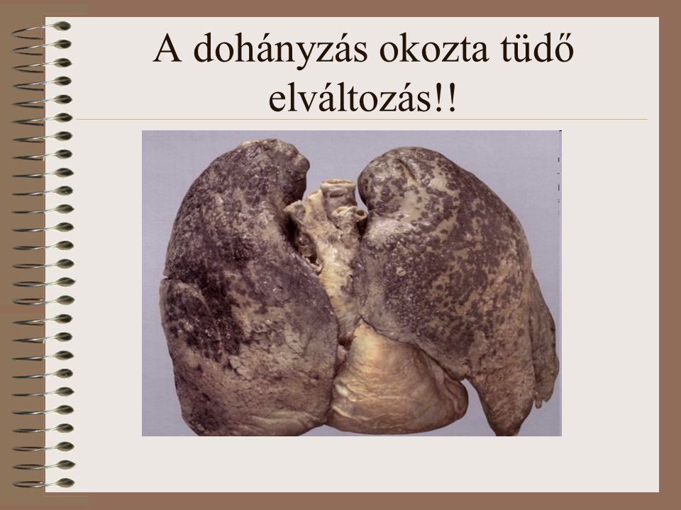 A dohányzás okozta tüdő elváltozás!!