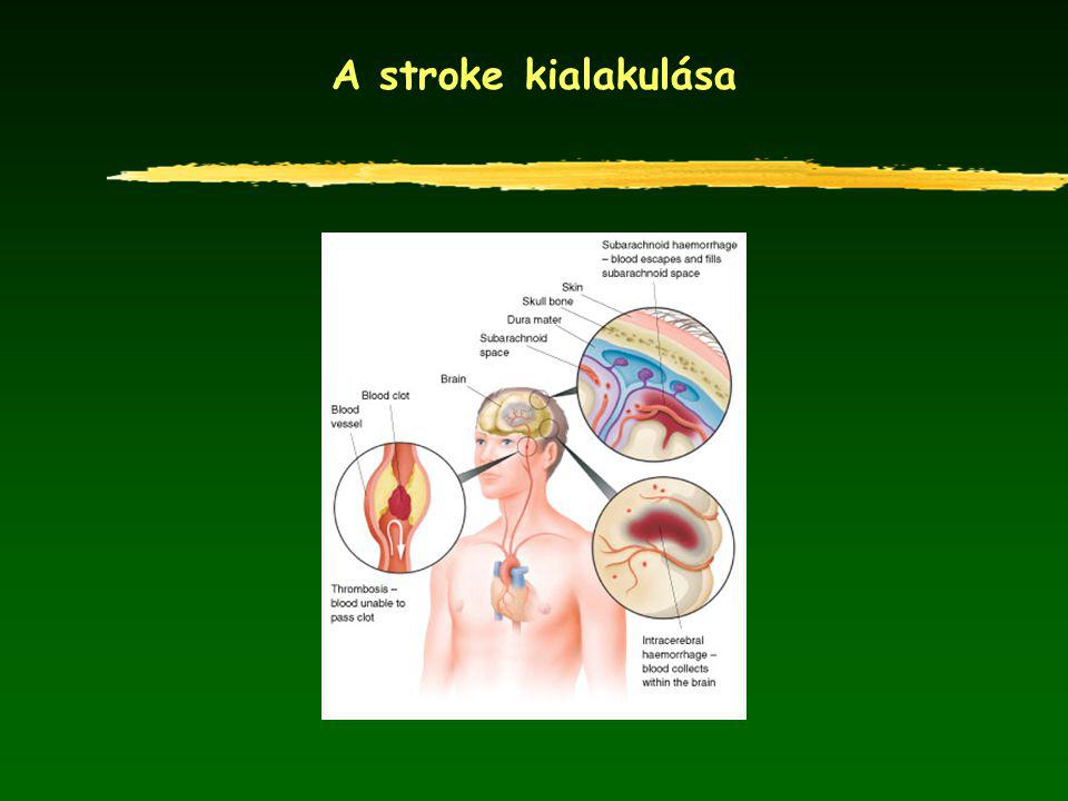 A stroke kialakulása