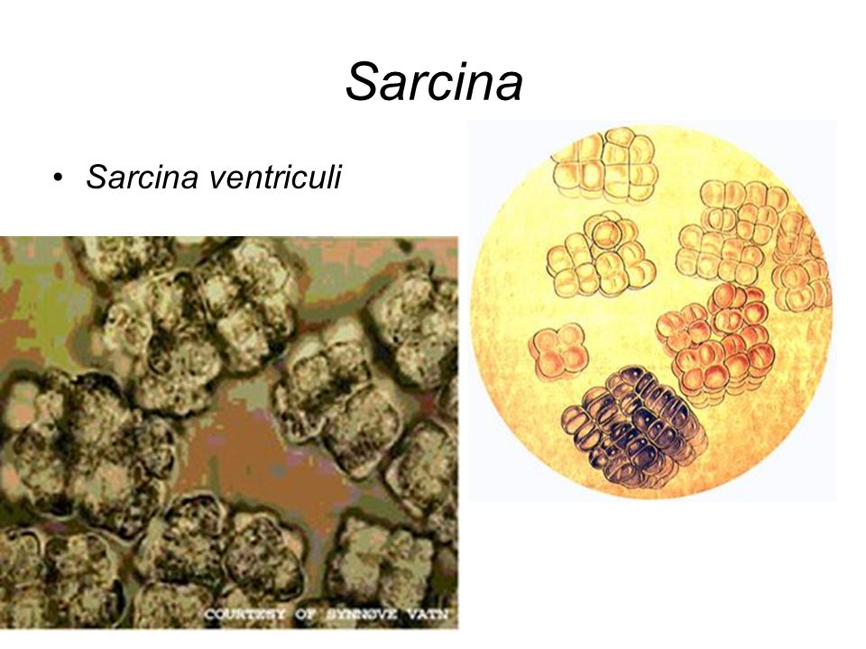 Sarcina Sarcina ventriculi