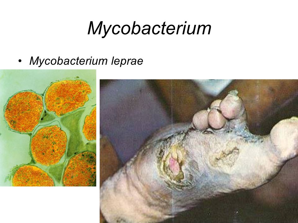 Mycobacterium Mycobacterium leprae