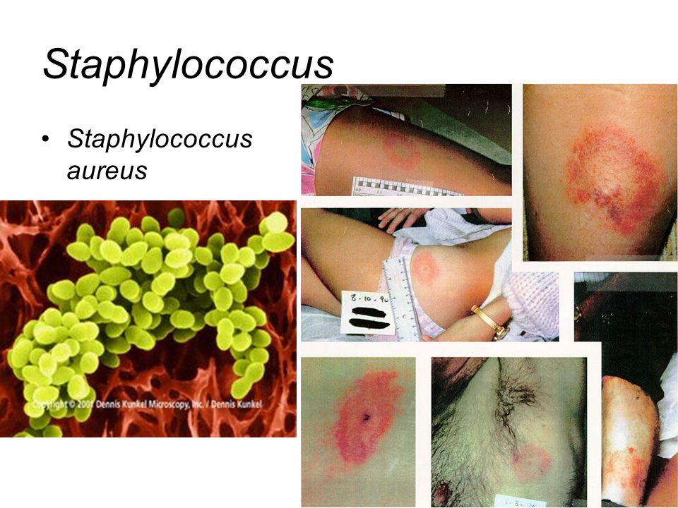 Staphylococcus Staphylococcus aureus