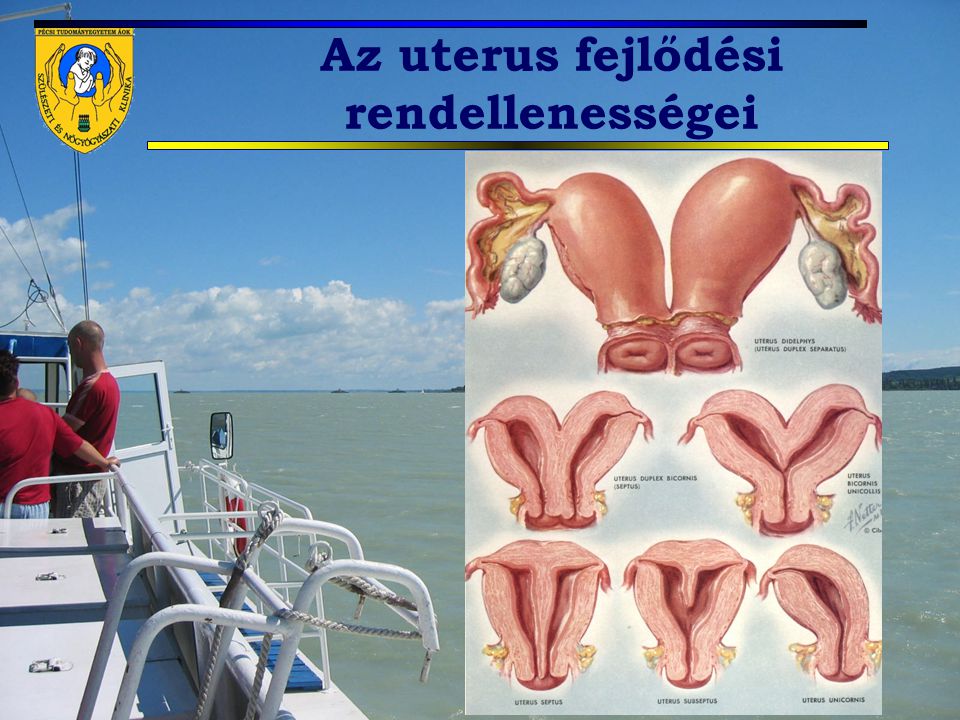 Uterus duplex terhesség