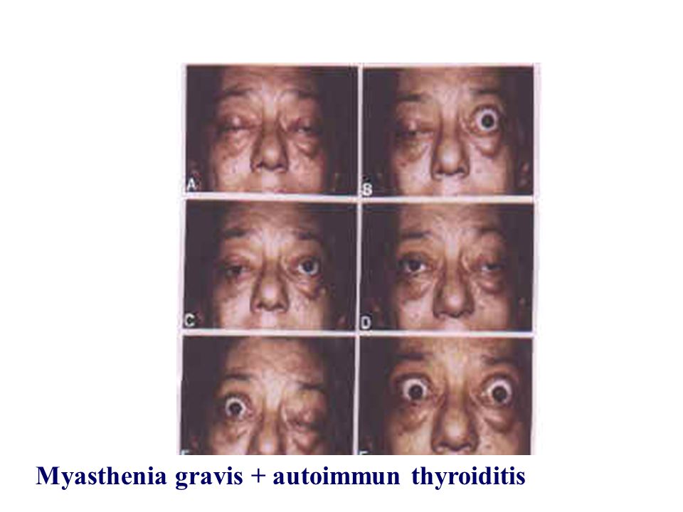 Myasthenia gravis + autoimmun thyroiditis