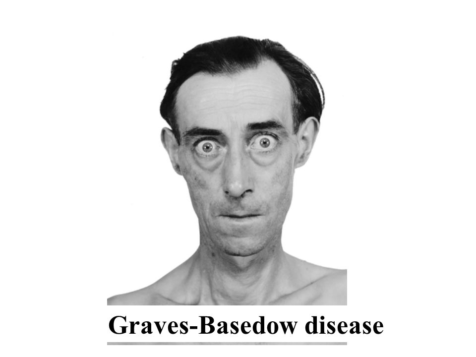 Graves-Basedow disease