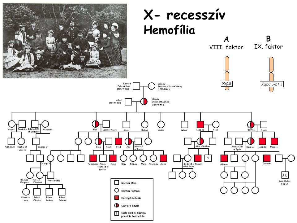 X- recesszív Hemofília B IX. faktor A VIII. faktor