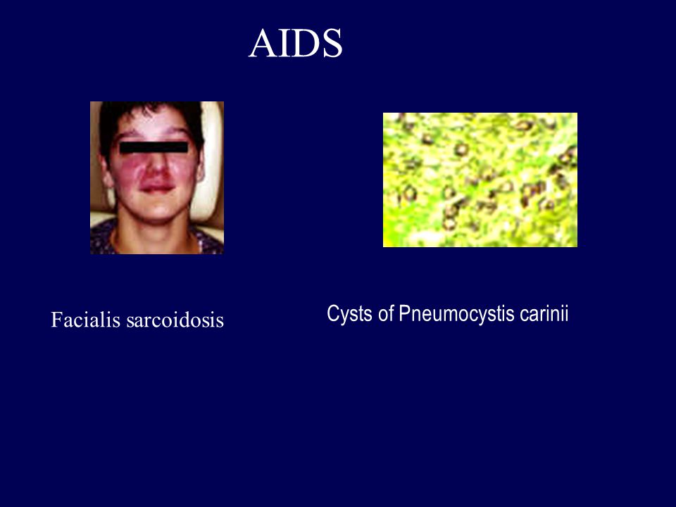 AIDS Cysts of Pneumocystis carinii Facialis sarcoidosis