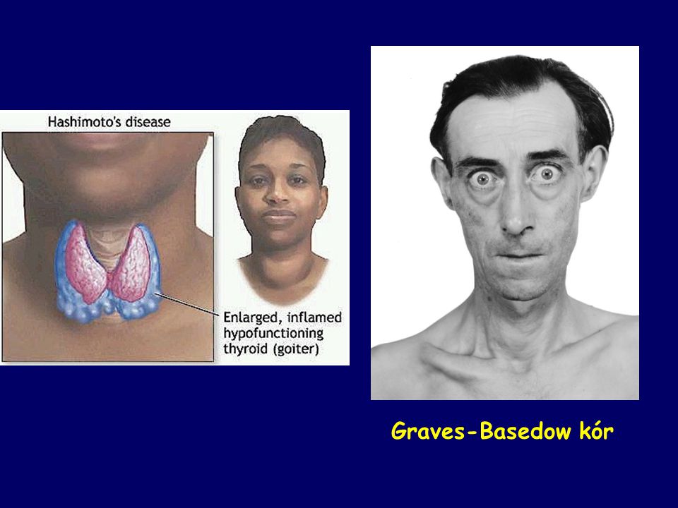 Graves-Basedow kór