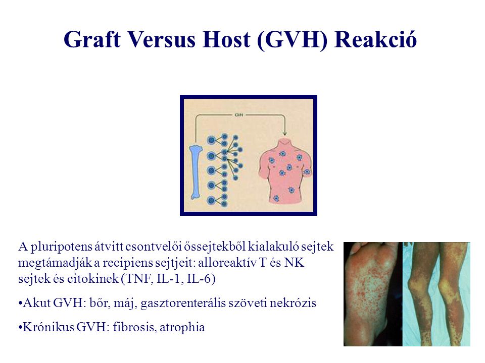 Graft Versus Host (GVH) Reakció