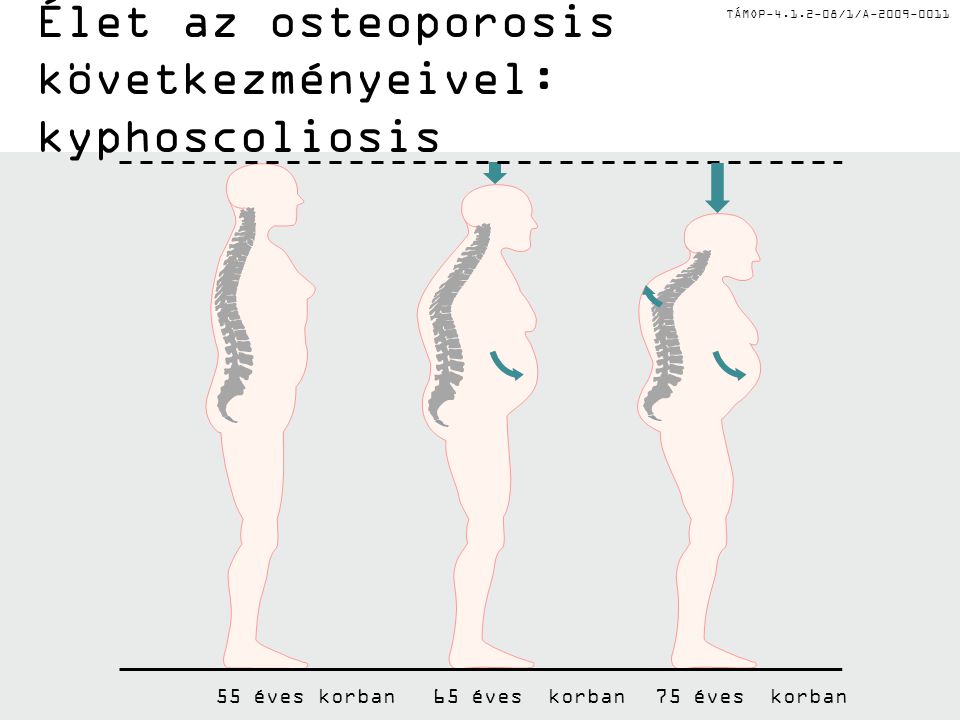 Élet az osteoporosis következményeivel: kyphoscoliosis