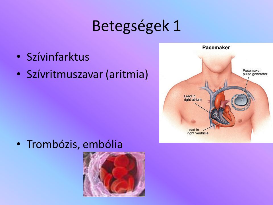 Betegségek 1 Szívinfarktus Szívritmuszavar (aritmia)