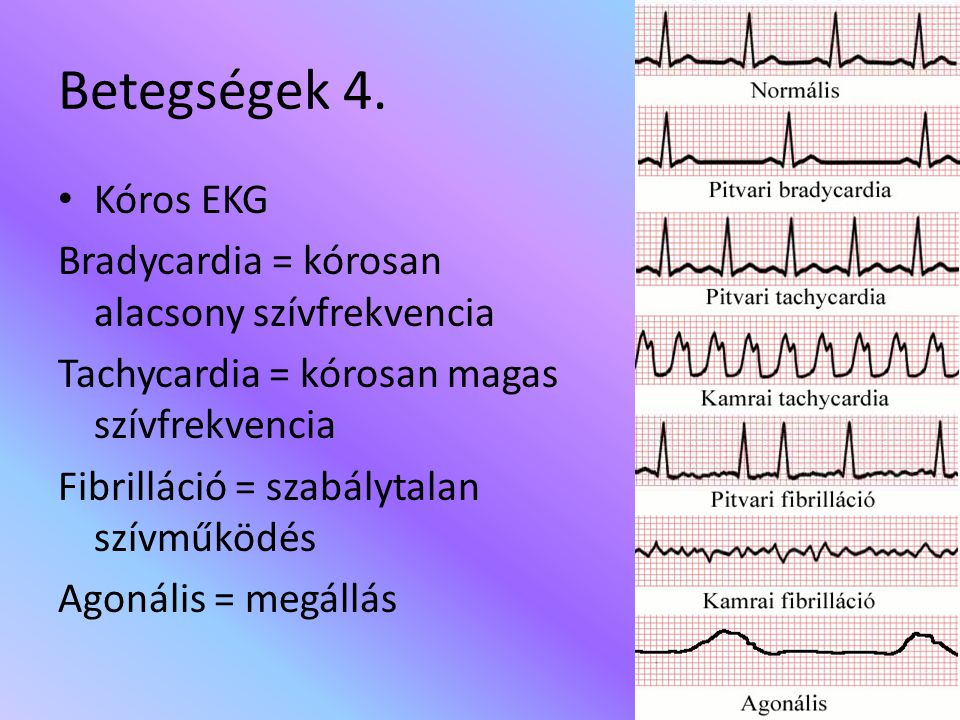 Betegségek 4. Kóros EKG Bradycardia = kórosan alacsony szívfrekvencia