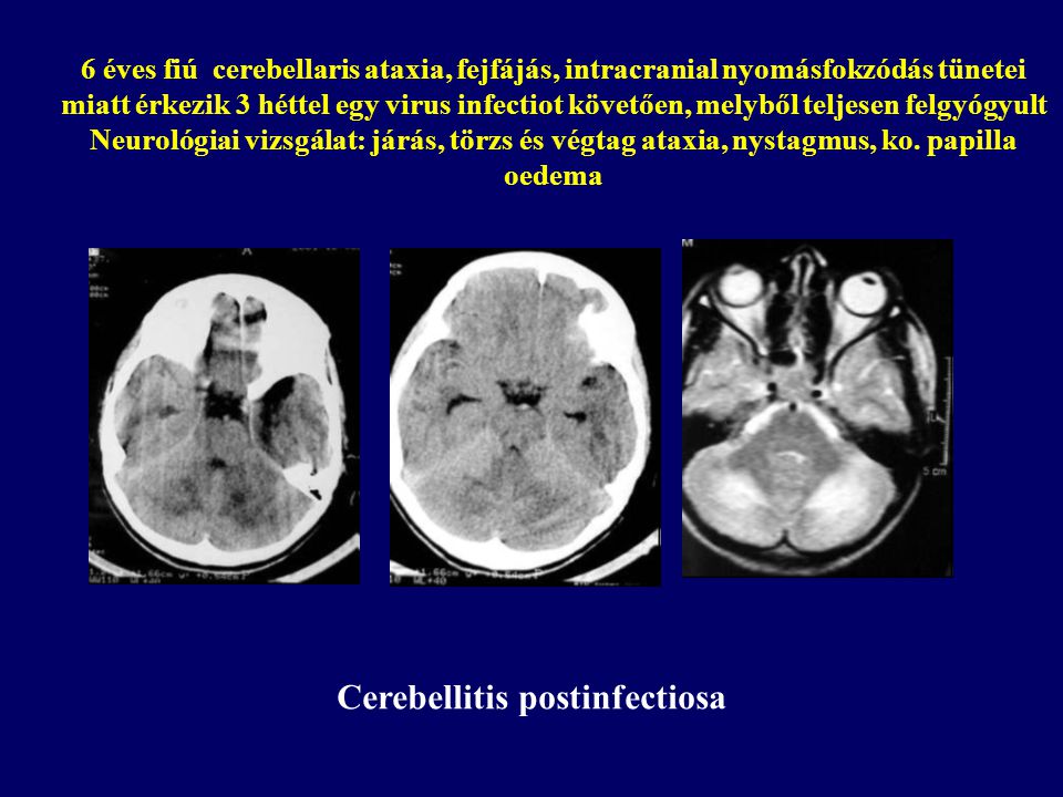 Cerebellitis postinfectiosa