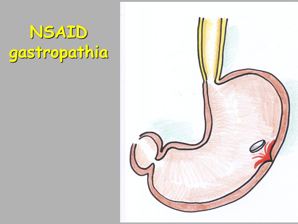 NSAID gastropathia