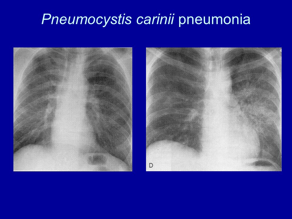 Pneumocystis carinii pneumonia
