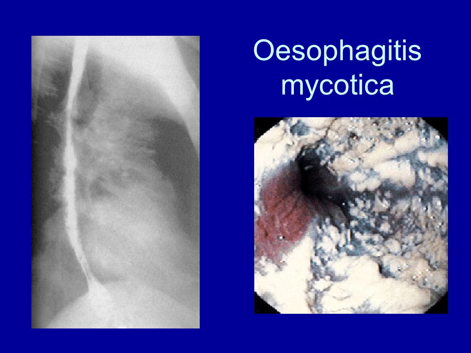 Oesophagitis mycotica
