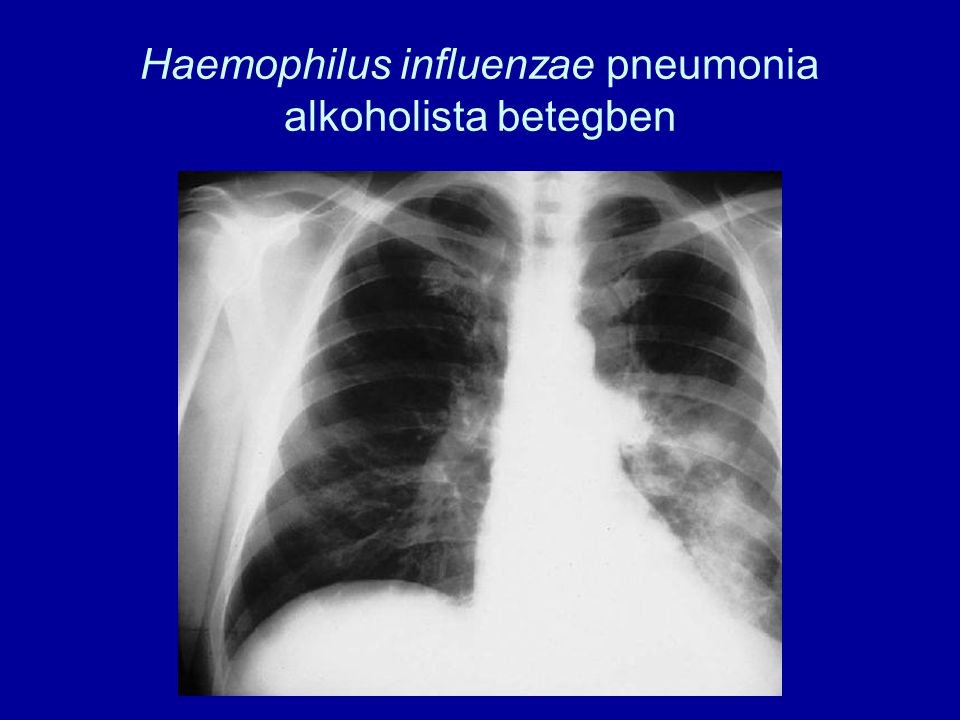 Haemophilus influenzae pneumonia alkoholista betegben