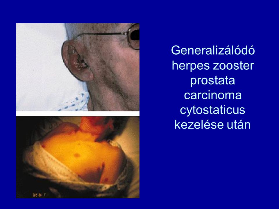 Generalizálódó herpes zooster prostata carcinoma cytostaticus kezelése után