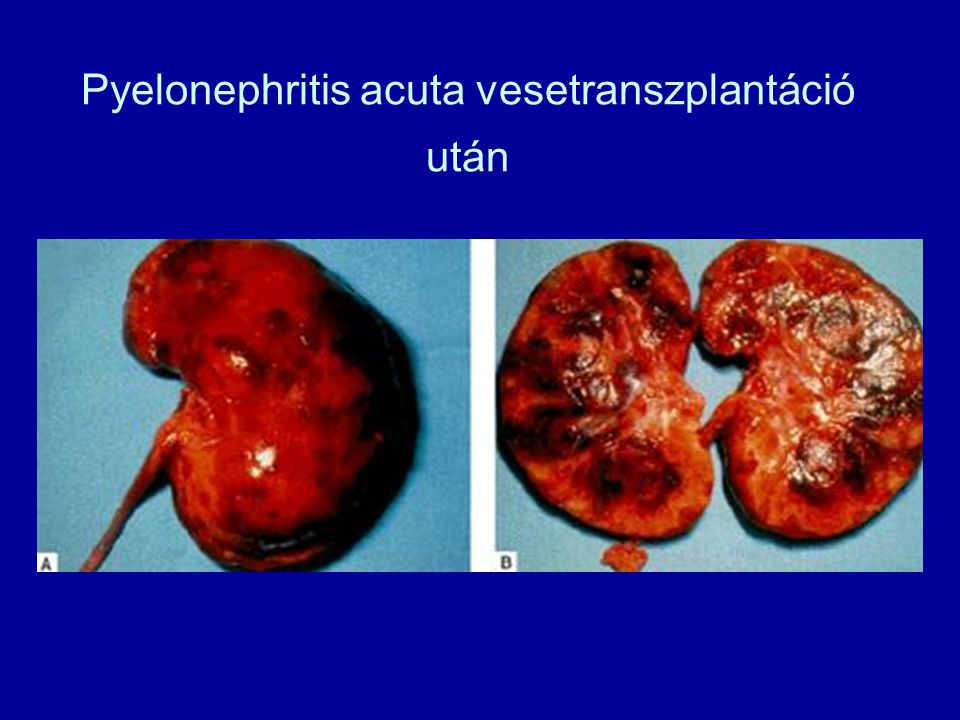Pyelonephritis acuta vesetranszplantáció után