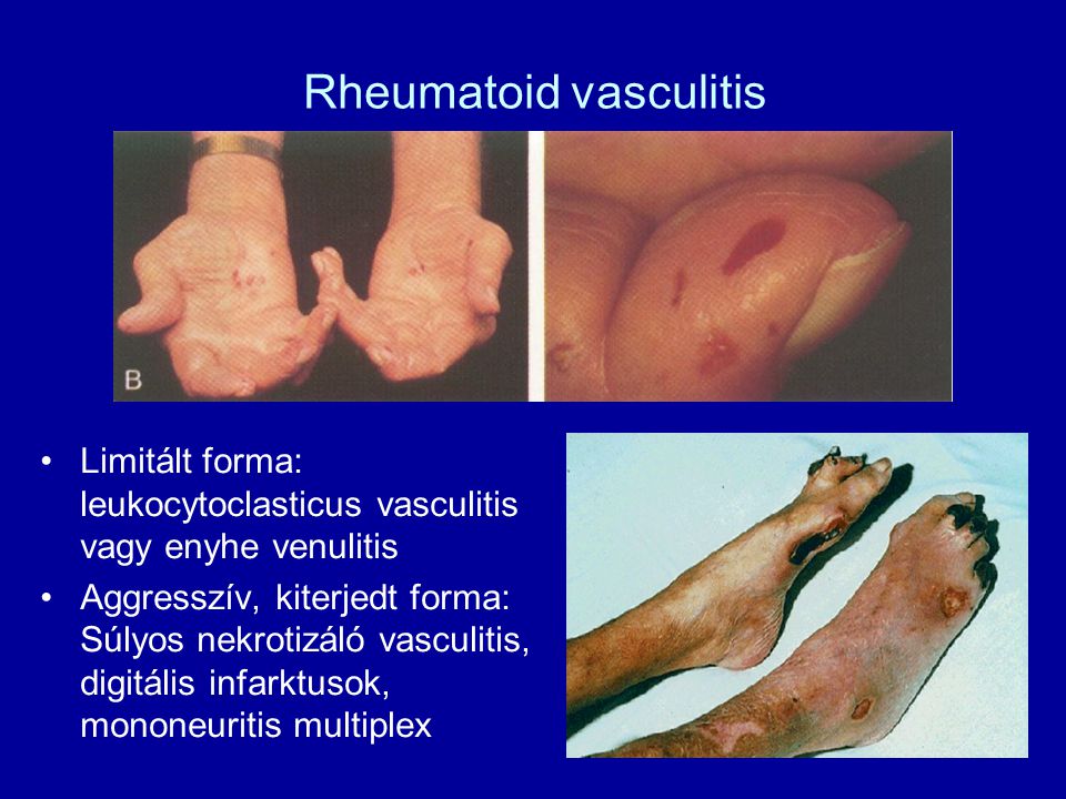 Rheumatoid vasculitis