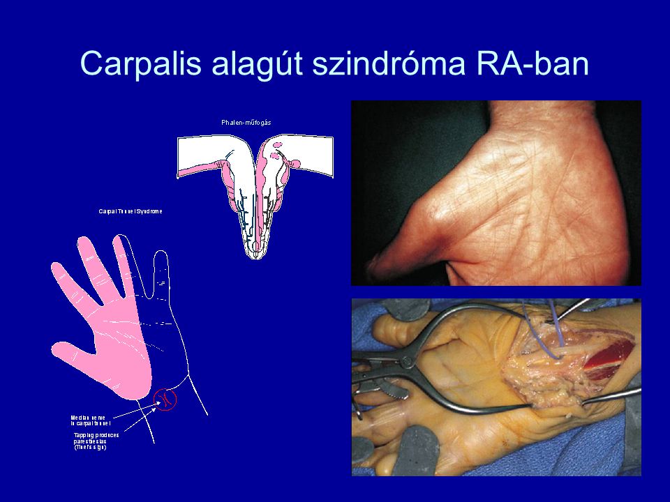 Carpalis alagút szindróma RA-ban