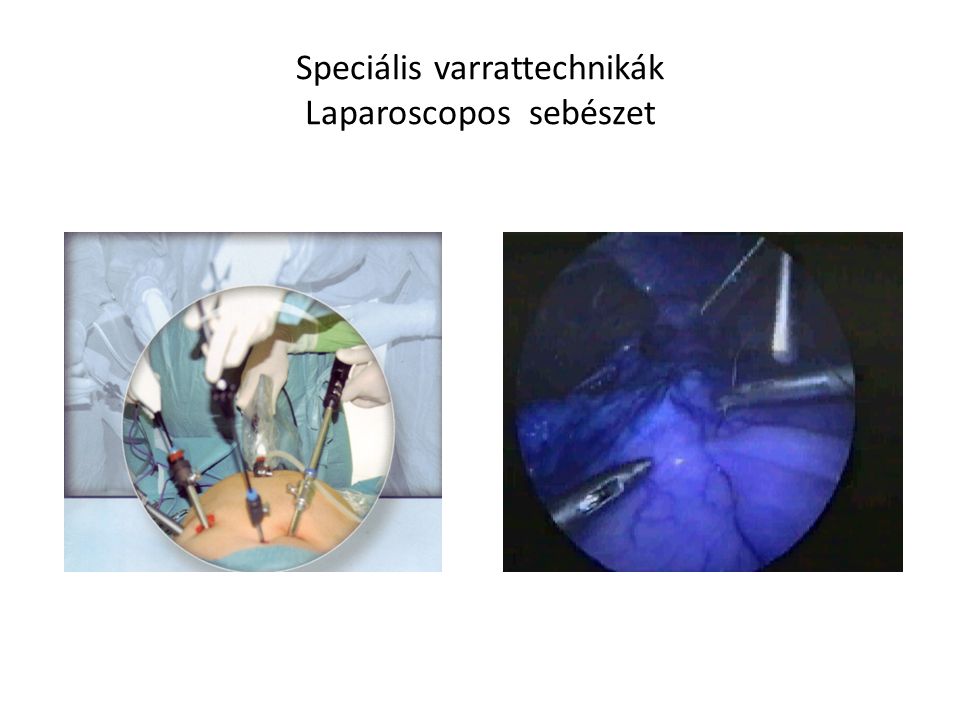 Speciális varrattechnikák Laparoscopos sebészet