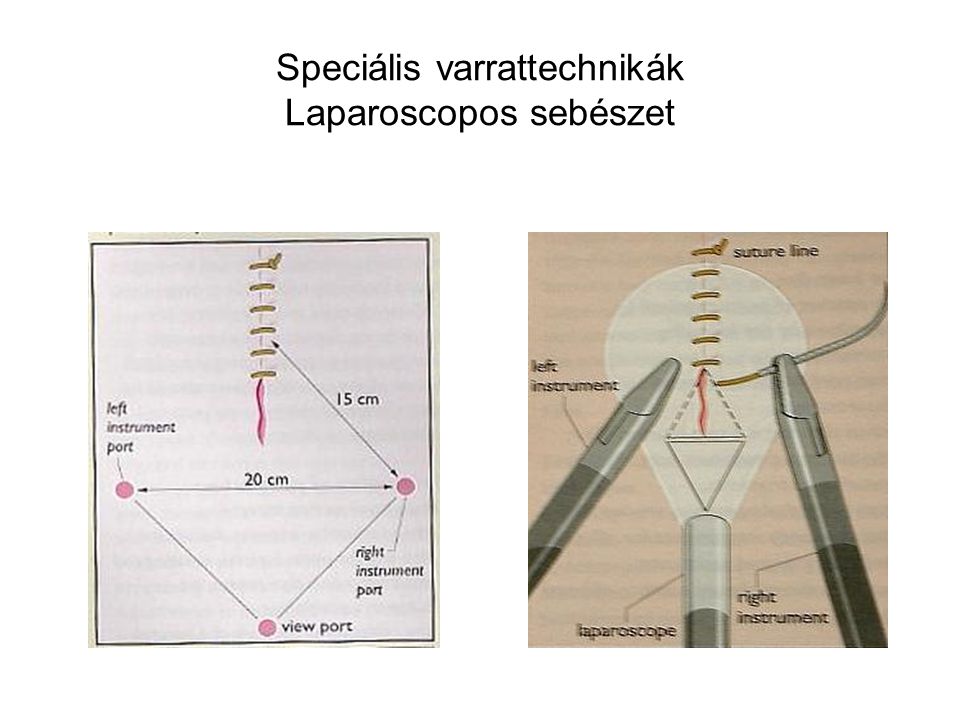 Speciális varrattechnikák Laparoscopos sebészet