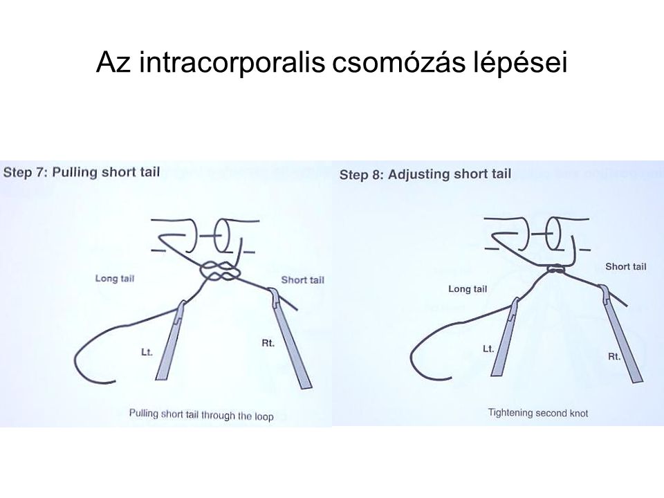 Az intracorporalis csomózás lépései