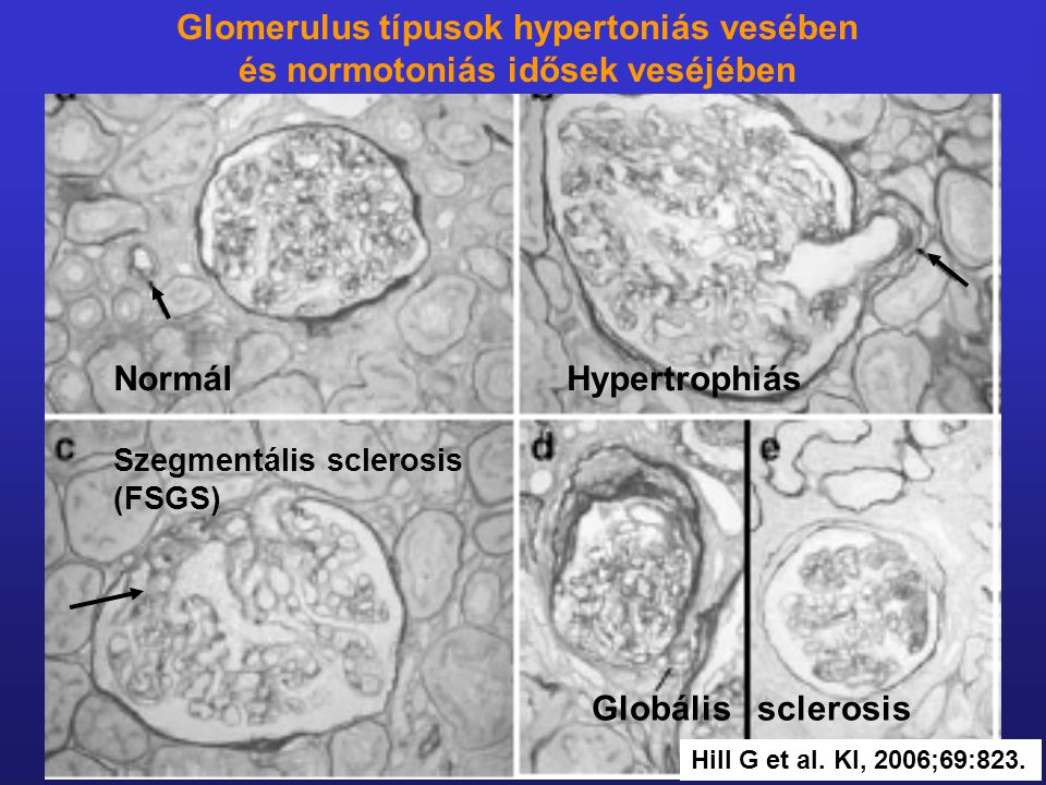 Glomerulus típusok hypertoniás vesében és normotoniás idősek veséjében