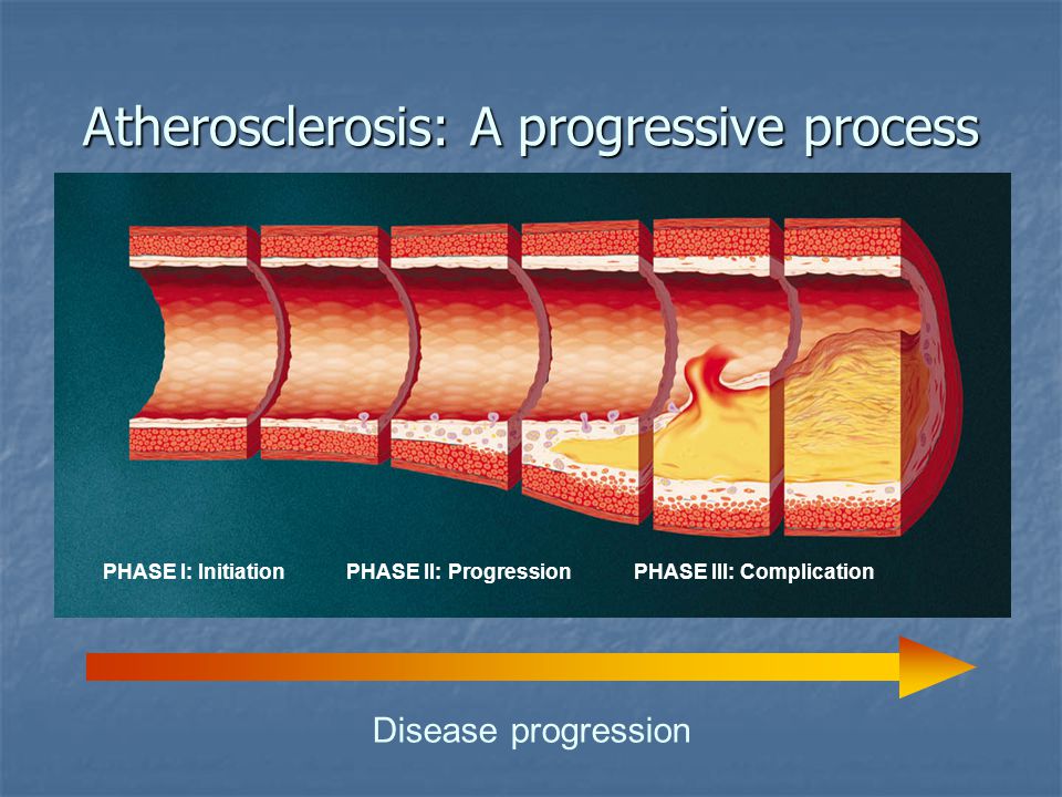 Atherosclerosis: A progressive process