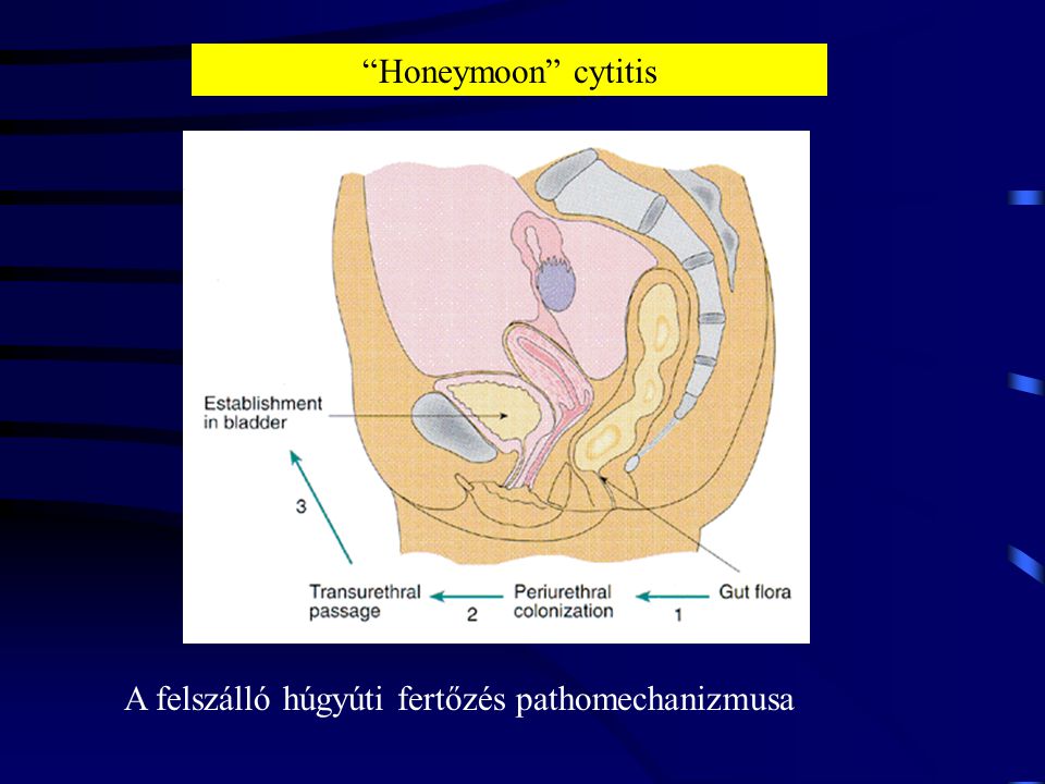Honeymoon cytitis A felszálló húgyúti fertőzés pathomechanizmusa