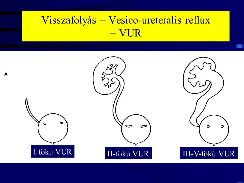 Visszafolyás = Vesico-ureteralis reflux = VUR