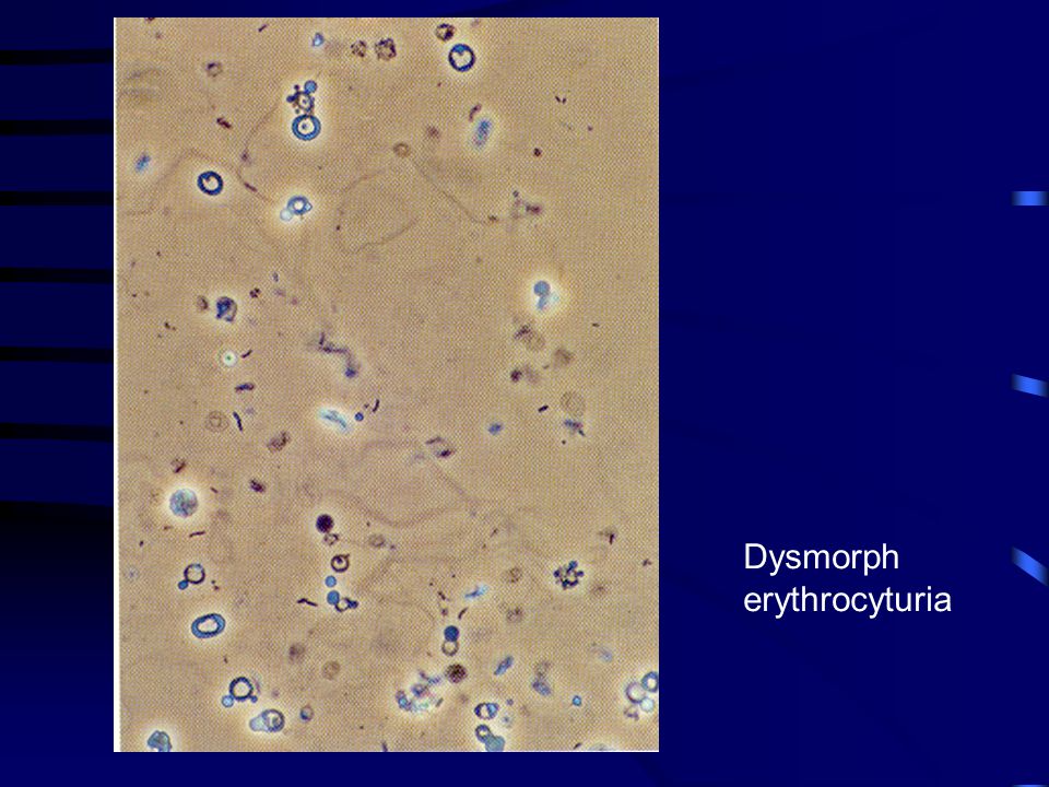 Dysmorph erythrocyturia
