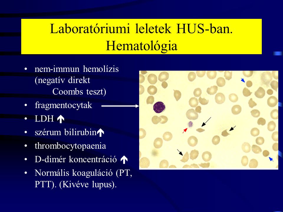 Laboratóriumi leletek HUS-ban. Hematológia