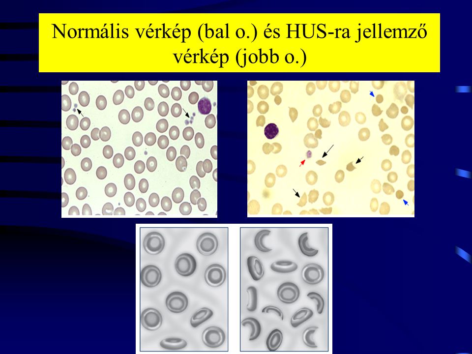 Normális vérkép (bal o.) és HUS-ra jellemző vérkép (jobb o.)