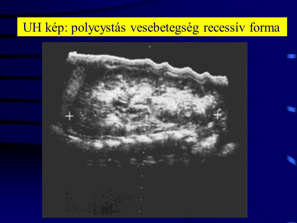 UH kép: polycystás vesebetegség recessív forma
