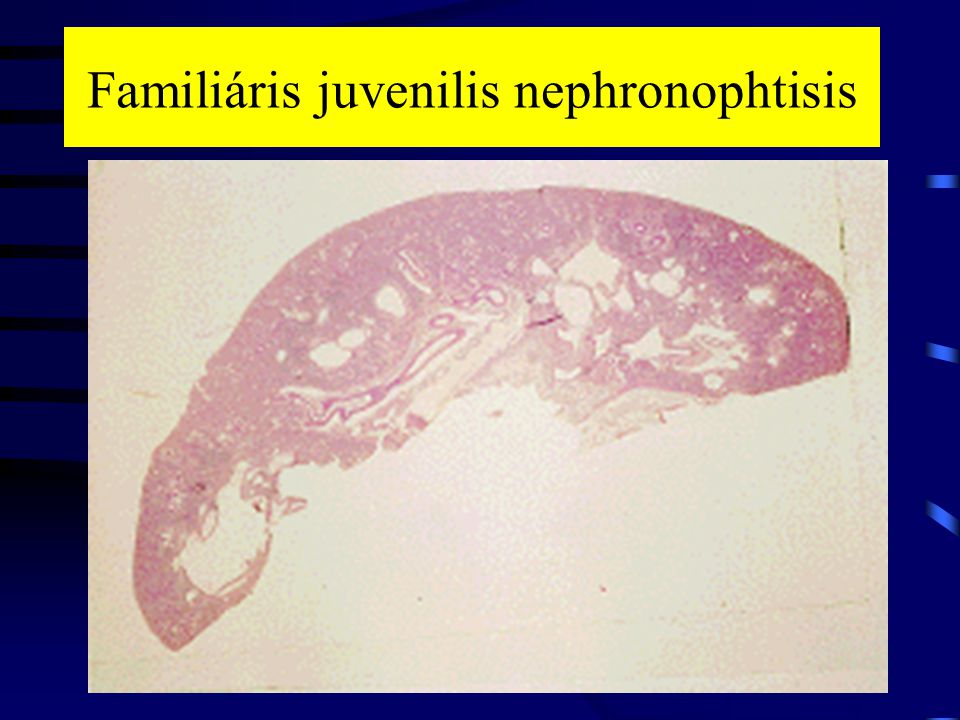 Familiáris juvenilis nephronophtisis