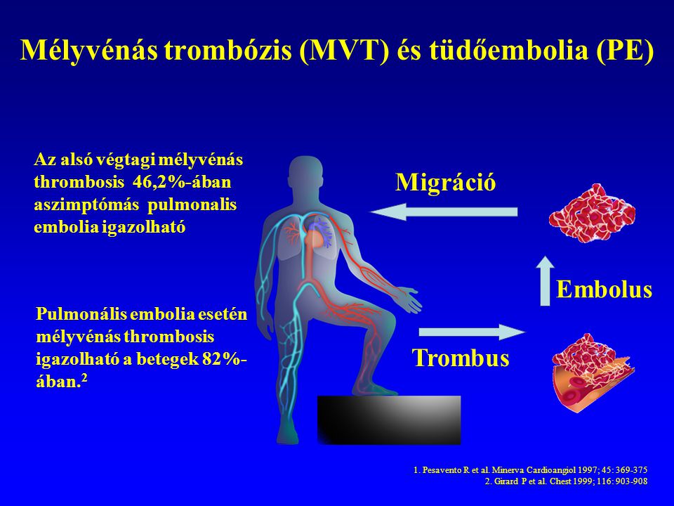 Mélyvénás trombózis (MVT) és tüdőembolia (PE)